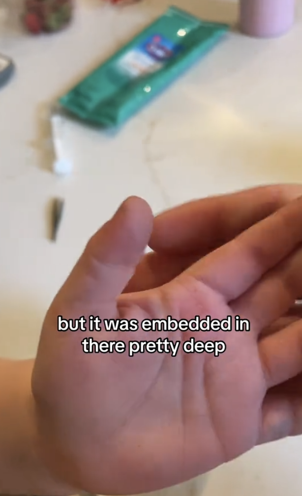 Mom's Splinter Removal TikTok Video Hack