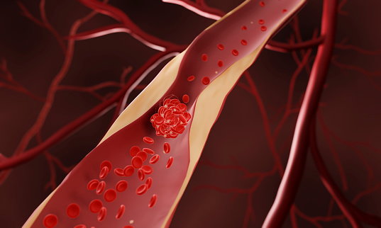 Blood clot, illustration