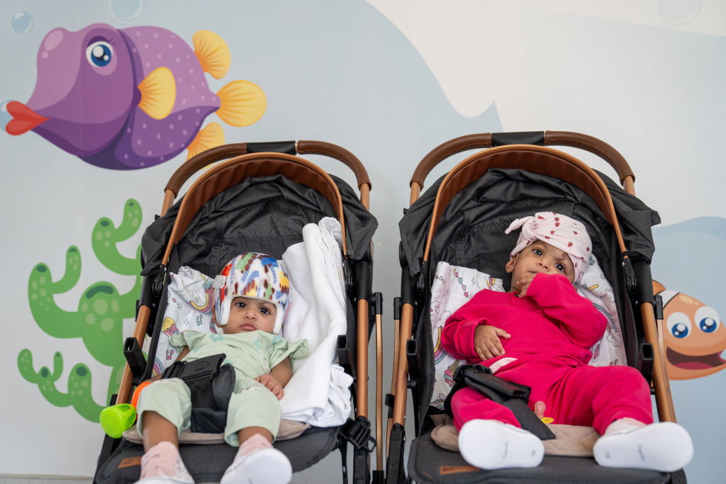 Pakistani conjoined twins separated after 14-hour operation in Turkiye