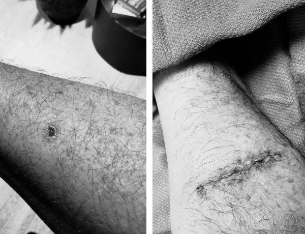 Julian's skin before and after surgery