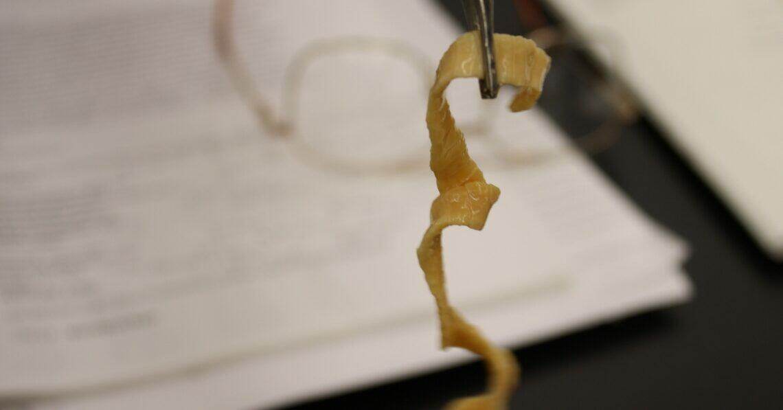 X-ray reveals cysts of tapeworm larvae in a patient