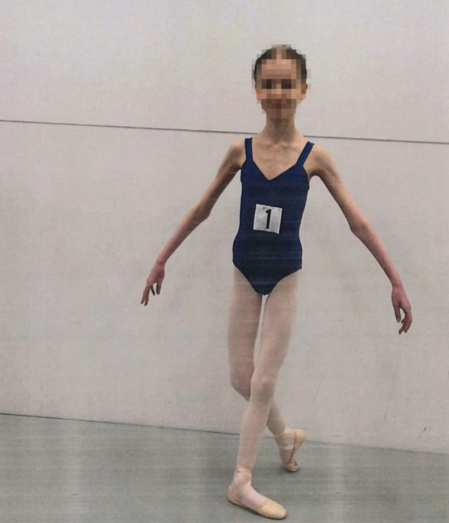 Girl ballerina starved by her parents (District Court of Western Australia)