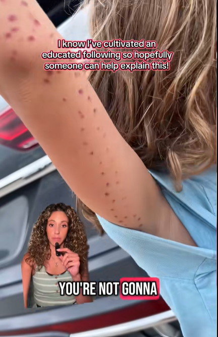 Octopus bruises on the boy's arm
