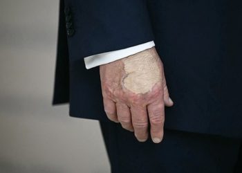 Trump hand covered in makeup